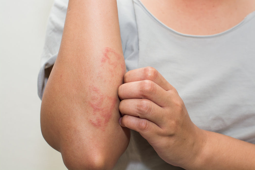 Skin rash treatment