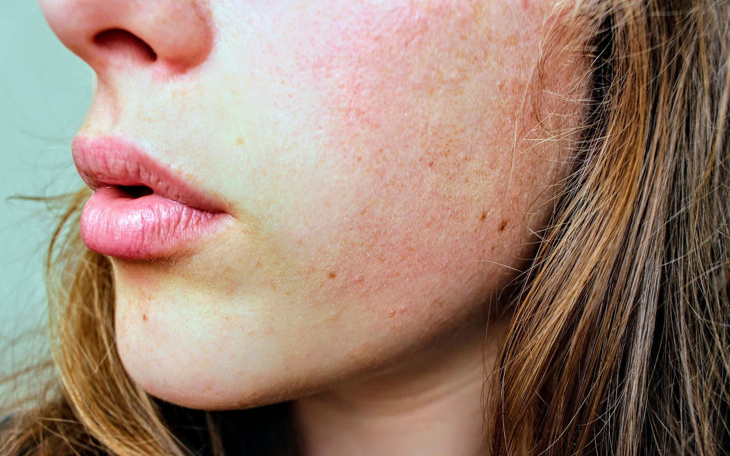 woman having rosacea before seeing Dr Jinah Yoo 